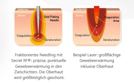 Laserbehandlung Wien