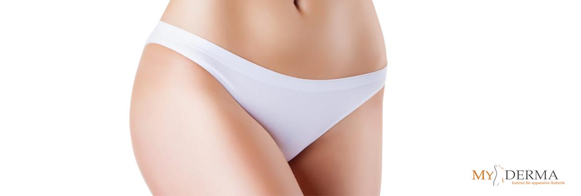 Dehnungsstreifen & Schwangerschaftsstreifen entfernen Wien